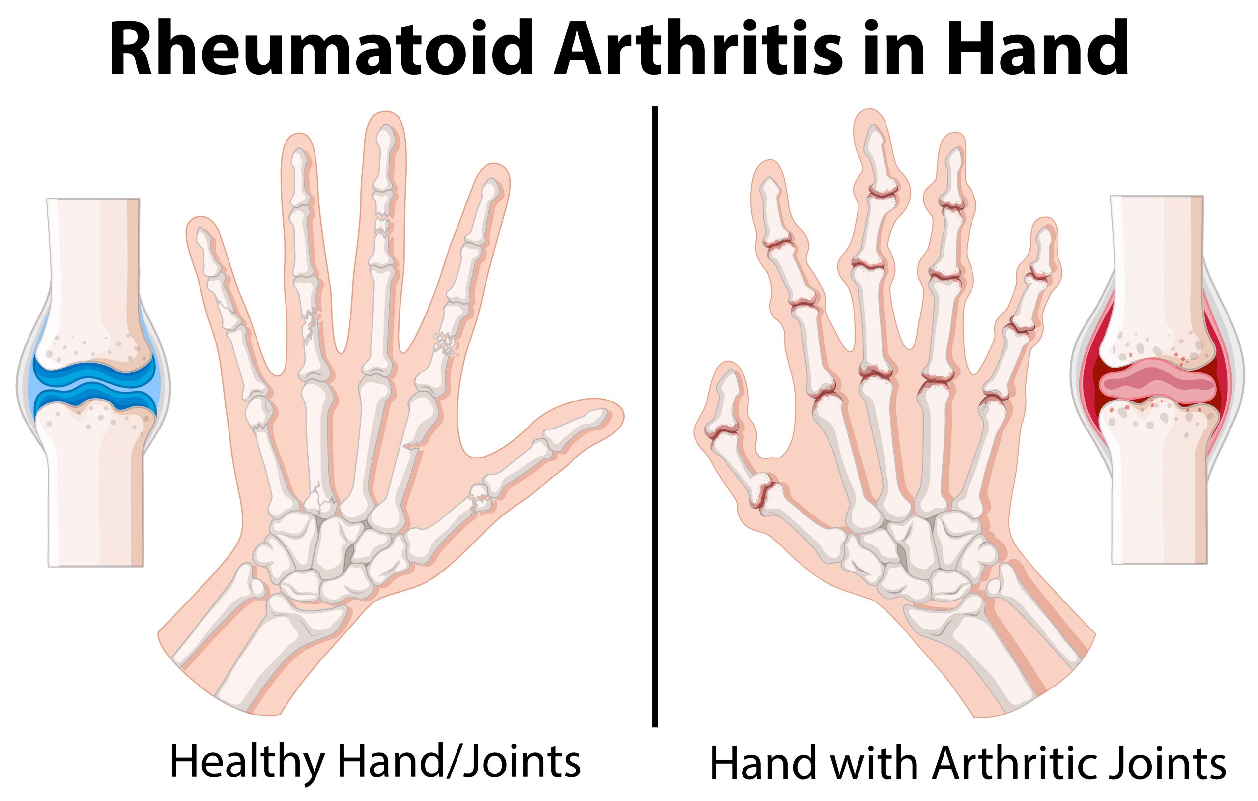 Diagram Showing Rheumatoid Arthritis In Hand